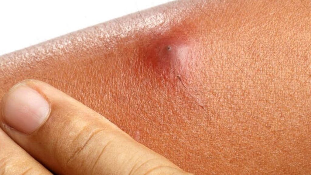 Abscesso