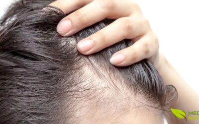 Calvície: Tratamento Natural Para Reduzir a Queda de Cabelo