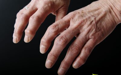 Artrose: 5 Soluções Naturais Comprovadas para Aliviar Dores